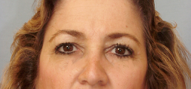 Lowcountry Lid Lift Blepharoplasty Before and After | Thomas Funcik MD