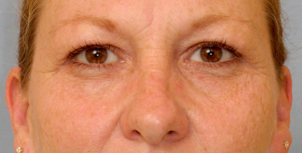 Lowcountry Lid Lift Blepharoplasty Before and After | Thomas Funcik MD