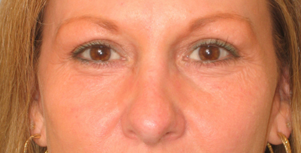 Lowcountry Lid Lift Blepharoplasty Before and After | Thomas Funcik MD