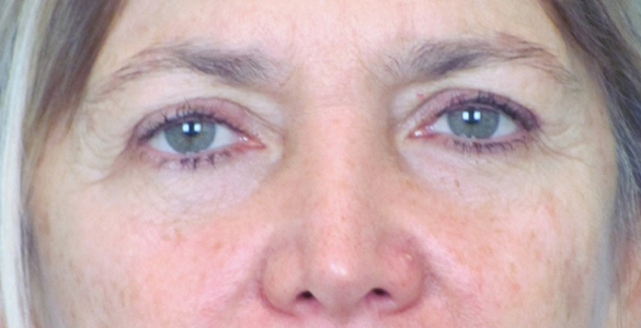 Lowcountry Lid Lift Blepharoplasty Before and After | Thomas Funcik MD