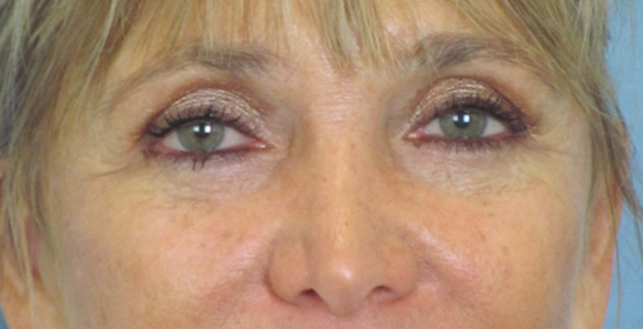 Lowcountry Lid Lift Blepharoplasty Before and After | Thomas Funcik MD