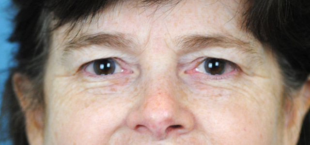 Lowcountry Lid Lift Blepharoplasty Before and After | Thomas Funcik MD