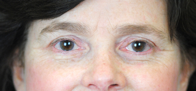 Lowcountry Lid Lift Blepharoplasty Before and After | Thomas Funcik MD