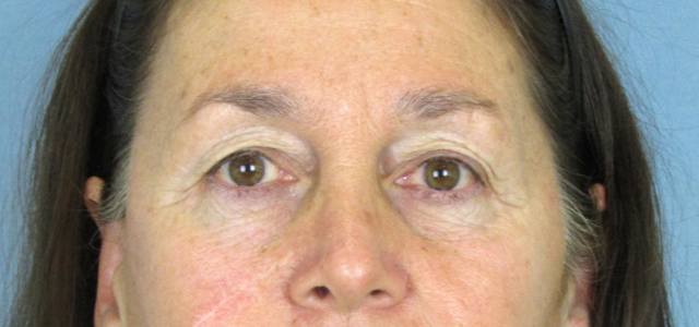 Lowcountry Lid Lift Blepharoplasty Before and After | Thomas Funcik MD