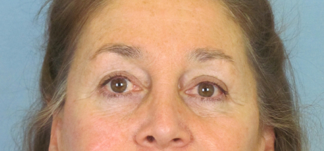 Lowcountry Lid Lift Blepharoplasty Before and After | Thomas Funcik MD