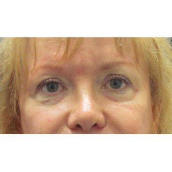 Lowcountry Lid Lift Blepharoplasty Before and After | Thomas Funcik MD