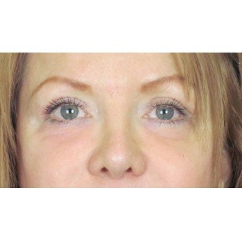 Lowcountry Lid Lift Blepharoplasty Before and After | Thomas Funcik MD