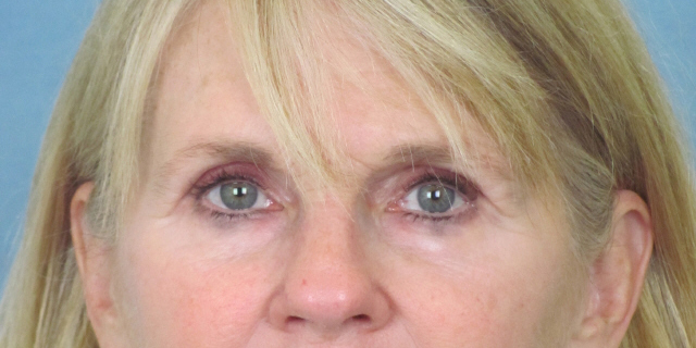 Lowcountry Lid Lift Blepharoplasty Before and After | Thomas Funcik MD