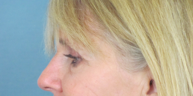 Lowcountry Lid Lift Blepharoplasty Before and After | Thomas Funcik MD