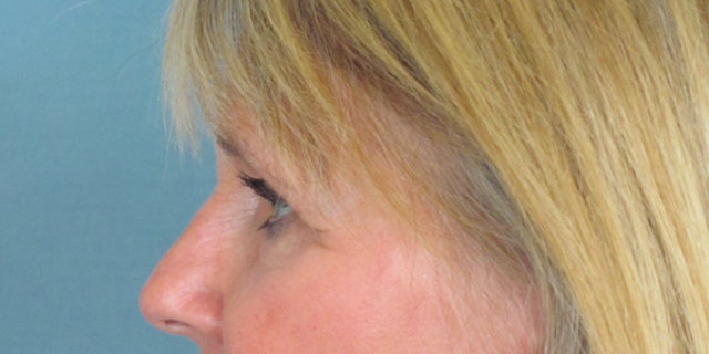 Lowcountry Lid Lift Blepharoplasty Before and After | Thomas Funcik MD