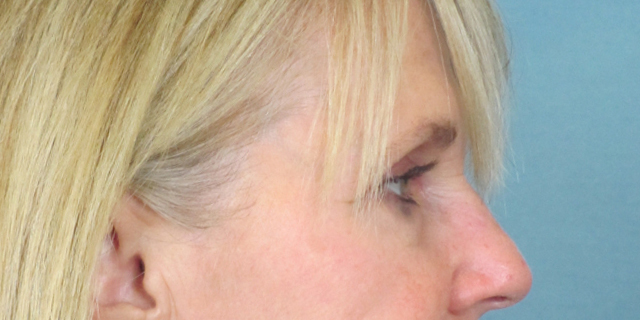 Lowcountry Lid Lift Blepharoplasty Before and After | Thomas Funcik MD