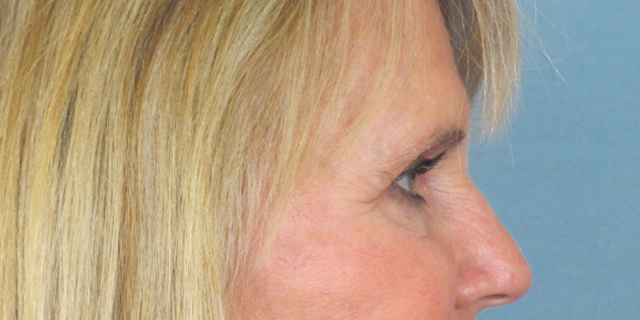 Lowcountry Lid Lift Blepharoplasty Before and After | Thomas Funcik MD