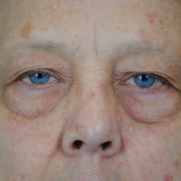 Lowcountry Lid Lift Blepharoplasty Before and After | Thomas Funcik MD