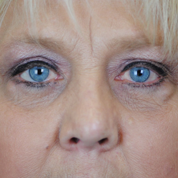 Lowcountry Lid Lift Blepharoplasty Before and After | Thomas Funcik MD