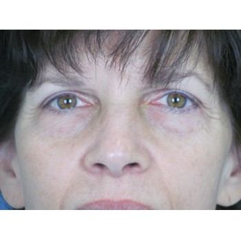 Lowcountry Lid Lift Blepharoplasty Before and After | Thomas Funcik MD