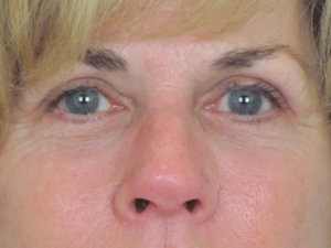 Lowcountry Lid Lift Blepharoplasty Before and After | Thomas Funcik MD