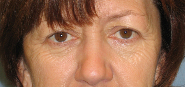 Lowcountry Lid Lift Blepharoplasty Before and After | Thomas Funcik MD