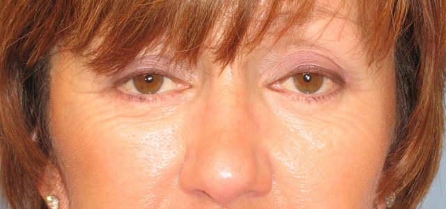 Lowcountry Lid Lift Blepharoplasty Before and After | Thomas Funcik MD