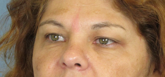 Lowcountry Lid Lift Blepharoplasty Before and After | Thomas Funcik MD