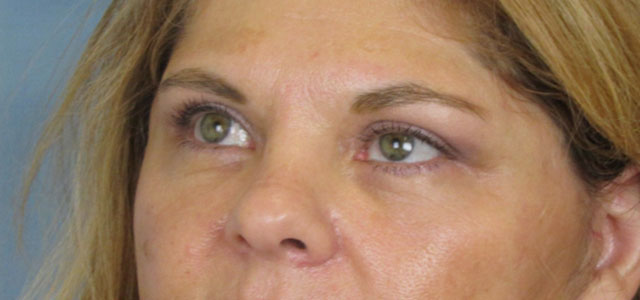 Lowcountry Lid Lift Blepharoplasty Before and After | Thomas Funcik MD