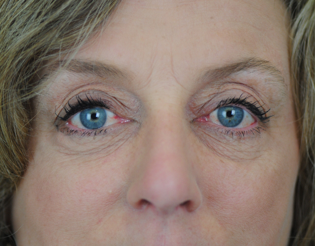 Lowcountry Lid Lift Blepharoplasty Before and After | Thomas Funcik MD