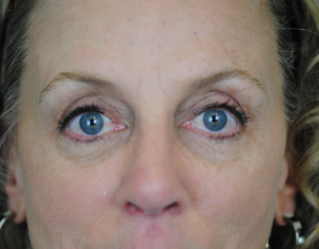 Lowcountry Lid Lift Blepharoplasty Before and After | Thomas Funcik MD