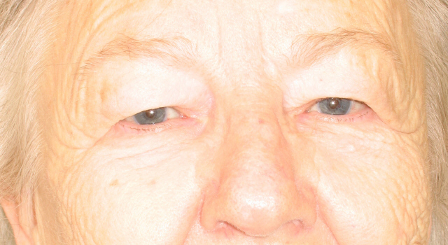 Lowcountry Lid Lift Blepharoplasty Before and After | Thomas Funcik MD