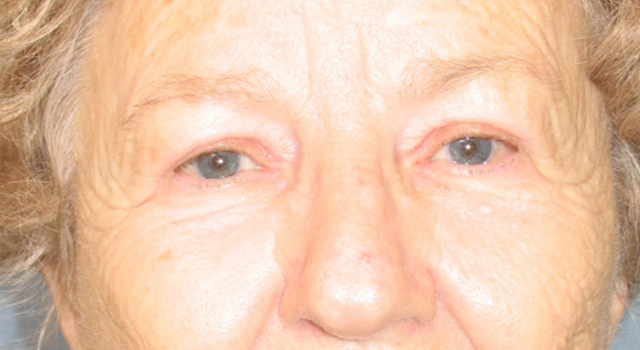 Lowcountry Lid Lift Blepharoplasty Before and After | Thomas Funcik MD