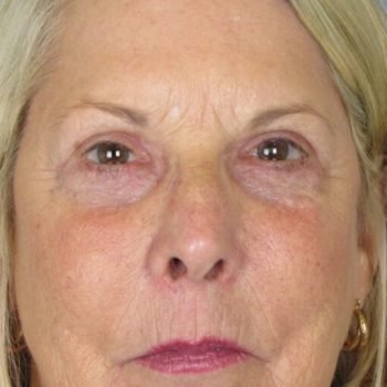 Lowcountry Lid Lift Blepharoplasty Before and After | Thomas Funcik MD