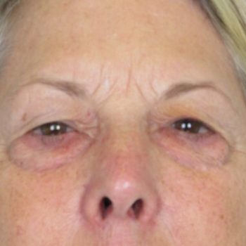 Lowcountry Lid Lift Blepharoplasty Before and After | Thomas Funcik MD