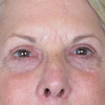 Lowcountry Lid Lift Blepharoplasty Before and After | Thomas Funcik MD