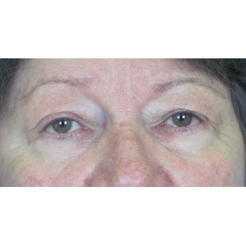 Lowcountry Lid Lift Blepharoplasty Before and After | Thomas Funcik MD