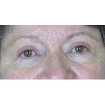 Lowcountry Lid Lift Blepharoplasty Before and After | Thomas Funcik MD