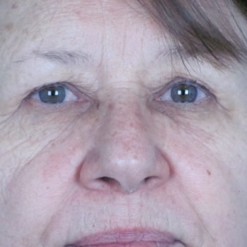 Lowcountry Lid Lift Blepharoplasty Before and After | Thomas Funcik MD