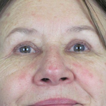 Lowcountry Lid Lift Blepharoplasty Before and After | Thomas Funcik MD