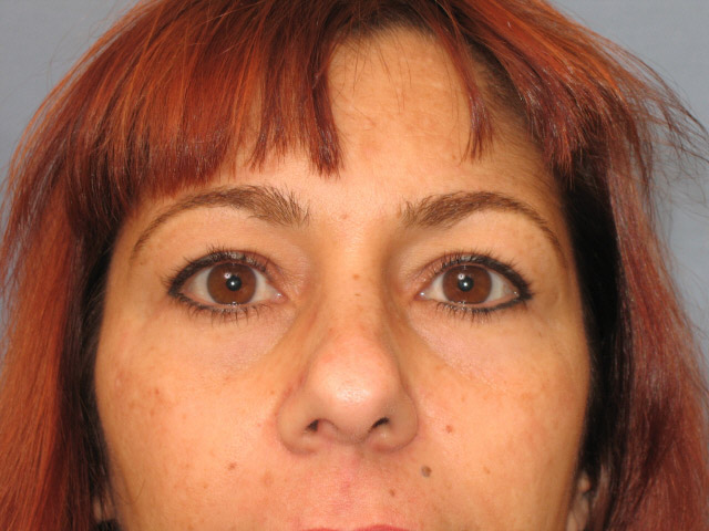 Lowcountry Lid Lift Blepharoplasty Before and After | Thomas Funcik MD