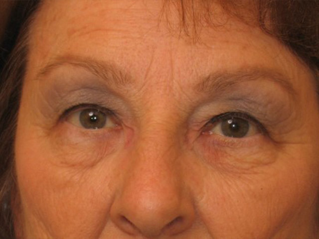 Lowcountry Lid Lift Blepharoplasty Before and After | Thomas Funcik MD