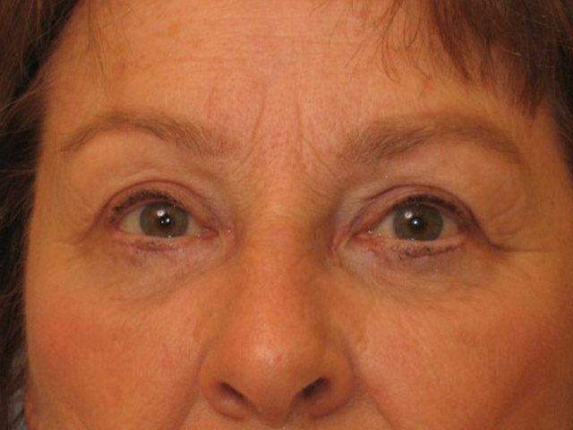 Lowcountry Lid Lift Blepharoplasty Before and After | Thomas Funcik MD