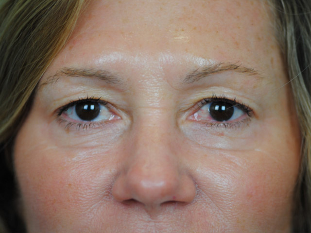 Lowcountry Lid Lift Blepharoplasty Before and After | Thomas Funcik MD