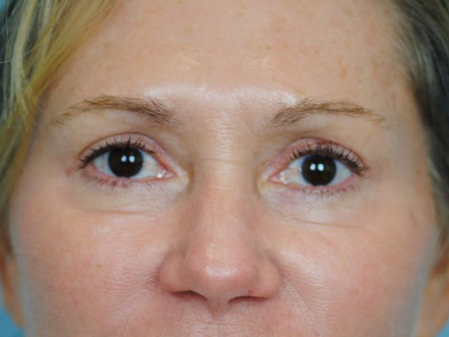 Lowcountry Lid Lift Blepharoplasty Before and After | Thomas Funcik MD