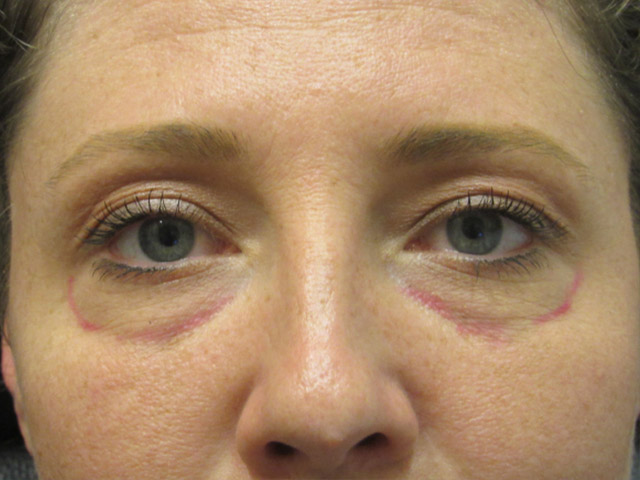 Lowcountry Lid Lift Blepharoplasty Before and After | Thomas Funcik MD