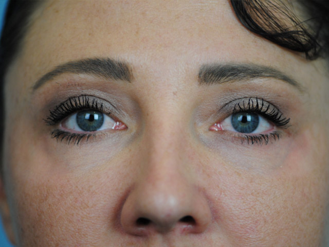 Lowcountry Lid Lift Blepharoplasty Before and After | Thomas Funcik MD