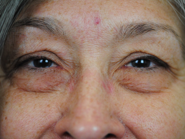 Lowcountry Lid Lift Blepharoplasty Before and After | Thomas Funcik MD