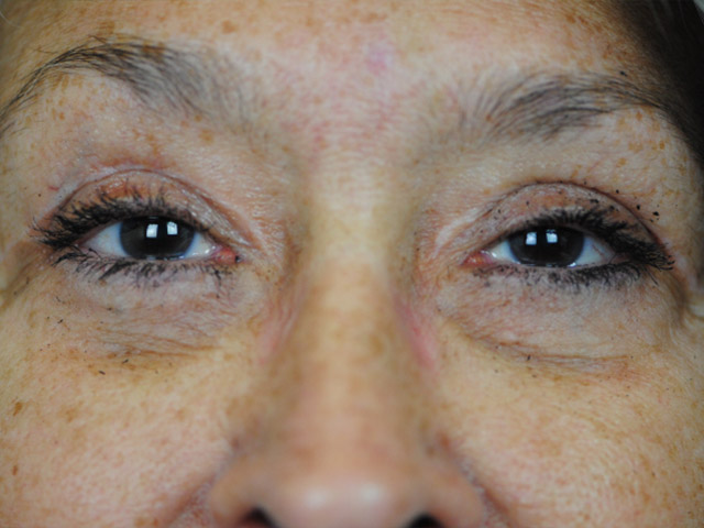 Lowcountry Lid Lift Blepharoplasty Before and After | Thomas Funcik MD