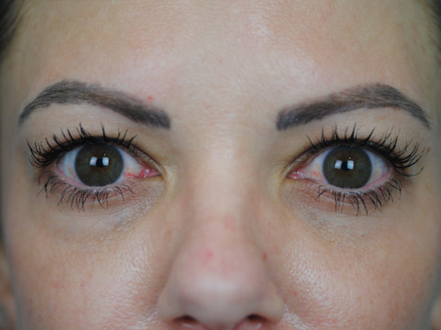 Lowcountry Lid Lift Blepharoplasty Before and After | Thomas Funcik MD