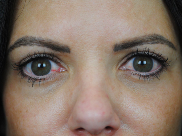 Lowcountry Lid Lift Blepharoplasty Before and After | Thomas Funcik MD