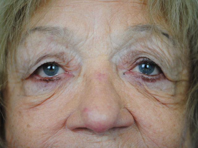 Lowcountry Lid Lift Blepharoplasty Before and After | Thomas Funcik MD