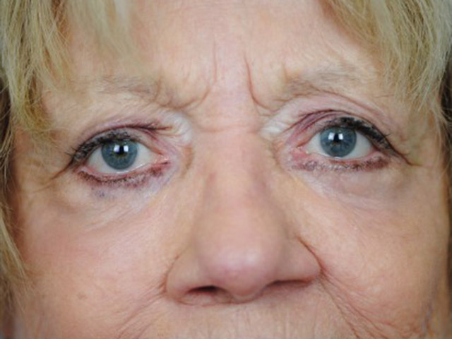 Lowcountry Lid Lift Blepharoplasty Before and After | Thomas Funcik MD