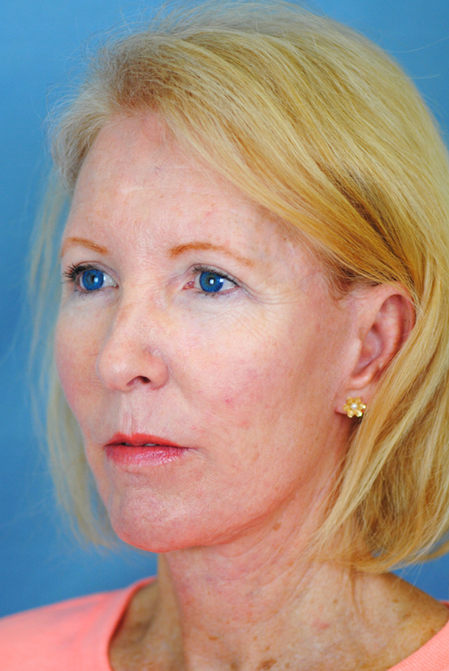 Otoplasty Before and After | Thomas Funcik MD