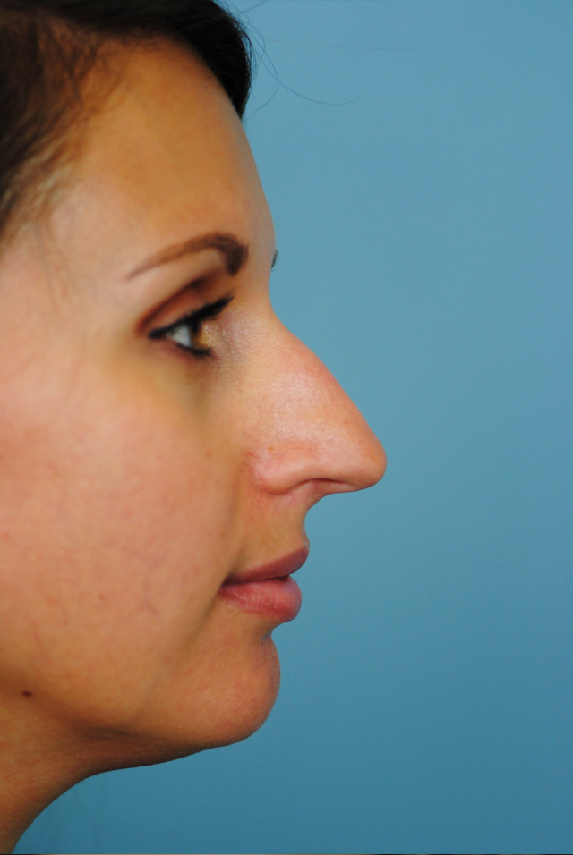 Rhinoplasty Before and After | Thomas Funcik MD